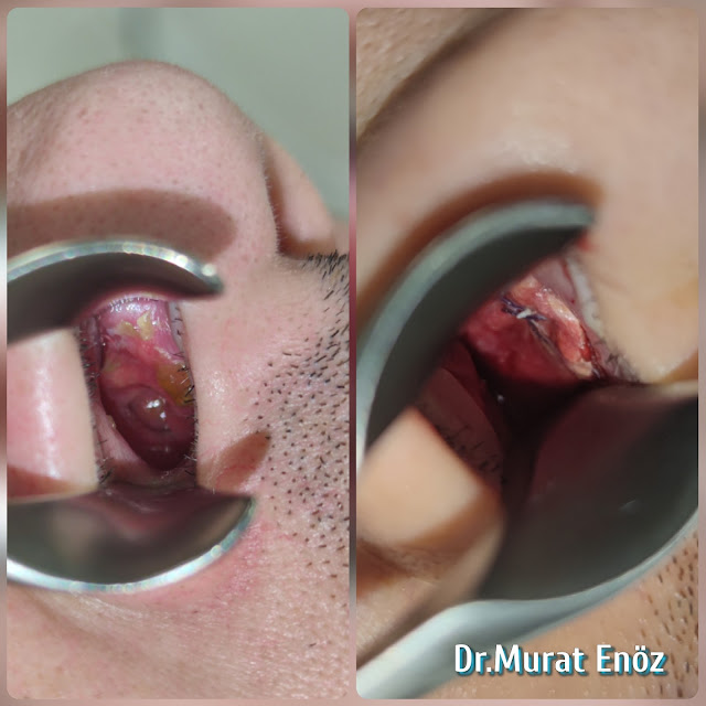 Three-Layer Nasal Septum Perforation Repairing - Fascia- Cartilage-Fascia