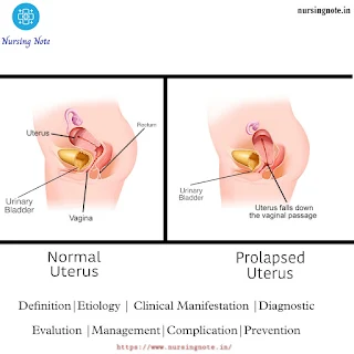 Difference between normal uterus and prolapsed uterus