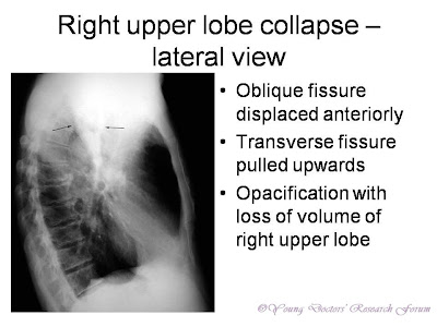 Oblique fissure displaced anteriorly Transverse fissure pulled upwards Opacification with loss of volume of right upper lobe