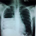 Plural effusion (Chest X ray - PA)