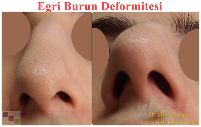 Eğri burun nedenleri - Eğri burun tanımı - Eğri burun estetiği - Eğri burun ameliyatı - Eğri burun tedavisindeki zorluklar - Crooked nose - Deviated nose - Twisted nose - Deflected nose - Asymmetric nose - Scoliotic nose - Eğri burun - C burun - S-shaped crooked nose deformity