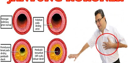 PENYEBAB Dan Pengobatan Jantung Koroner