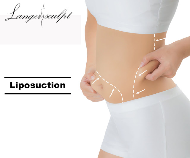 Liposuction Treatment