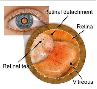 Blurred vision Flashes of light An increase in the number of spots or 