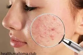 How to Get Rid of Acne with Accutane