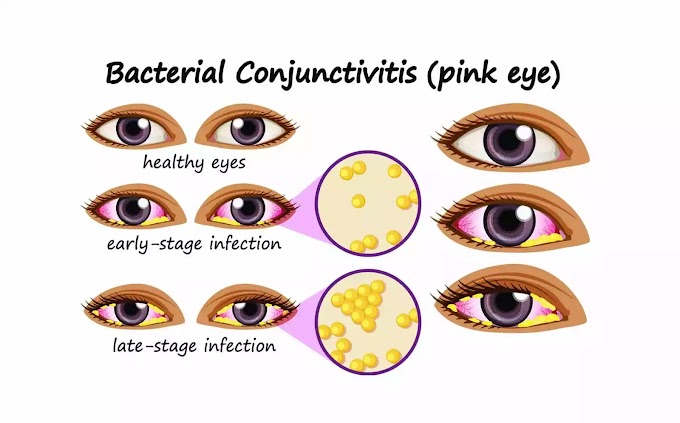 Eye Flu, Conjunctivitis: Causes, Symptoms, and Treatment