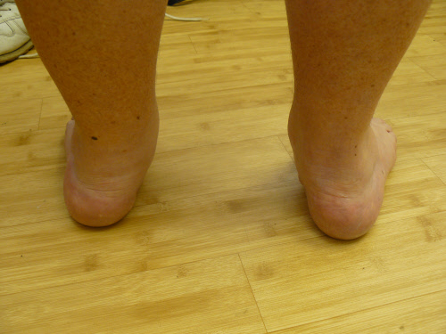 Paragon Physiotherapy Away with the flat  feet AAF Beware 