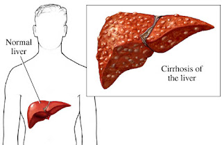 Liver Cirrhosis Treatment