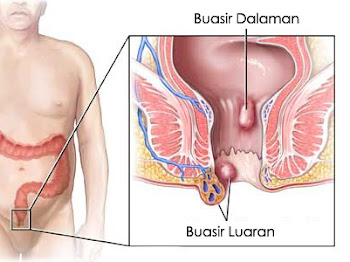 Rasa Macam Terkeluar Sesuatu..Adakah Itu Buasir?