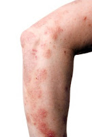 dermatitis Numuler causes, symptoms and treatment