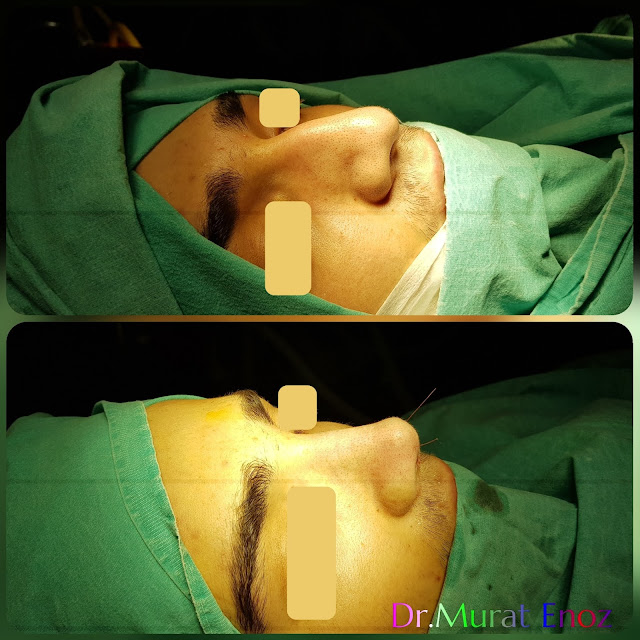 Male thick skinned rhinoplasty, Nose job for men Istanbul Turkey