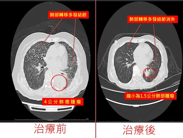 ▲病人經過治療後，腫瘤由4公分縮小為1.5公分且肺部轉移多發結節消失。（大里仁愛醫院提供）