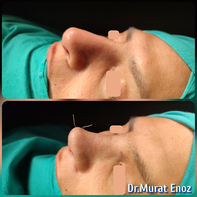 Tertiary Revision Nose Job Rib Cartilage Grafts Removal