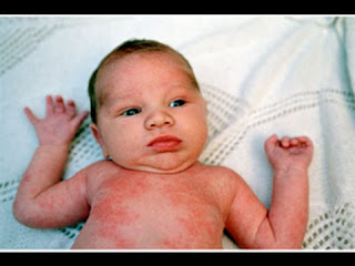 OObat Herpes Untuk Bayi Ampuh