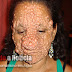 Mulher teve rosto deformado devido a doença rara no Estado da Paraiba
