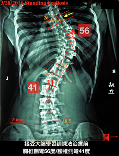 脊椎側彎, 脊椎度數,脊椎側彎矯正, 脊椎側彎治療, 脊椎側彎 物理治療