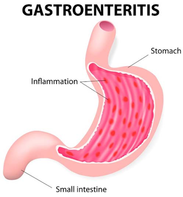 Laboratory diagnosis of gastroenteritis