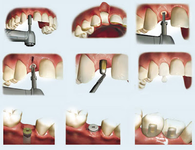 Implant nha khoa là giải pháp hoàn hảo