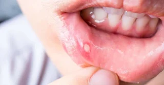  Mouth Ulcers Make You Suffer