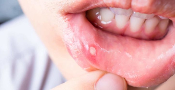 Your Mouth Ulcers Make You Suffer? Here's How To Treat Them In Minutes Without Medication