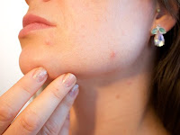Cure Acne With These 6 Home Remedies
