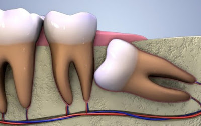 Cần thận trọng khi tiến hành nhổ răng khôn