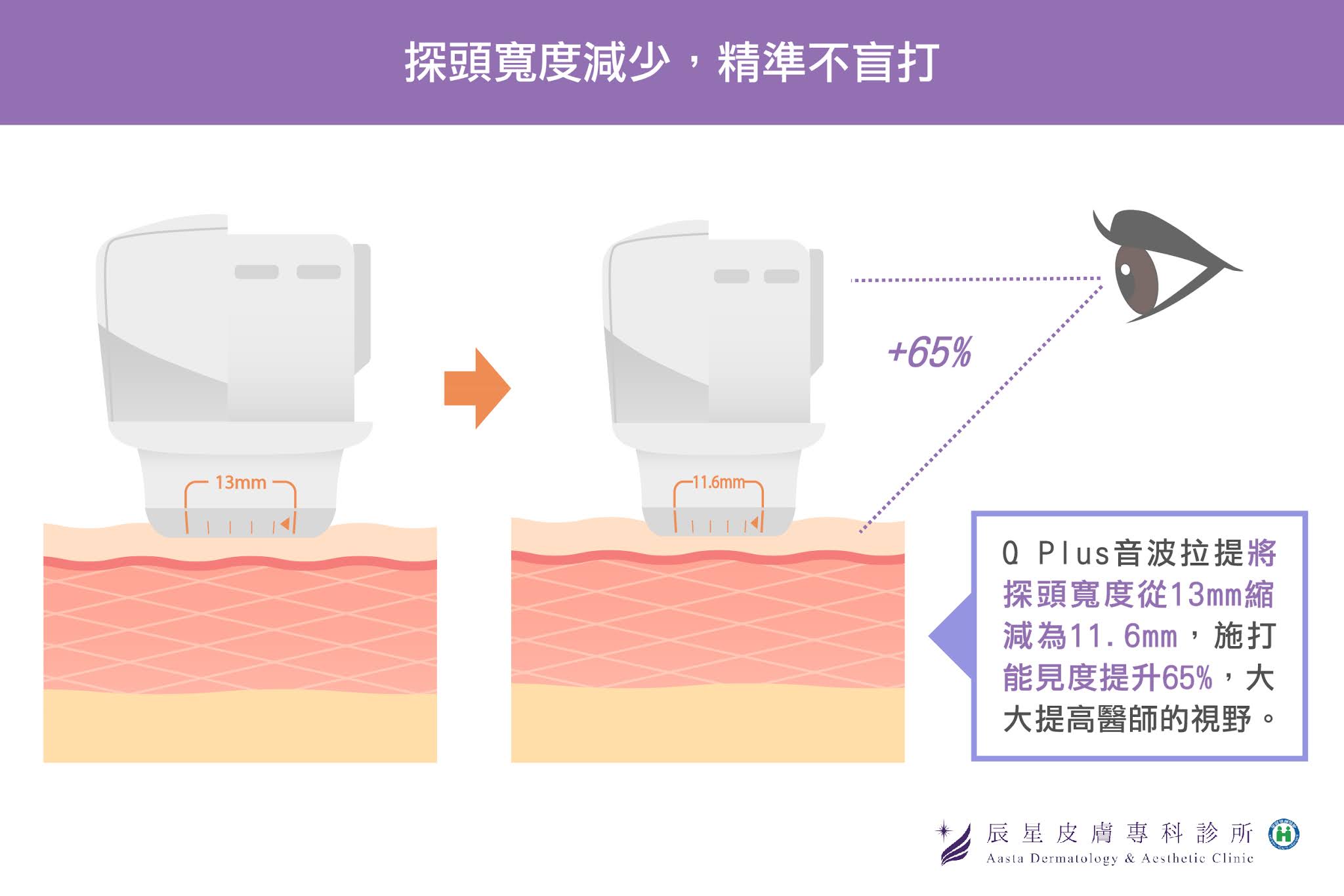 Qplus效果