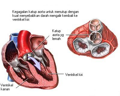 Regurgitasi katup aorta