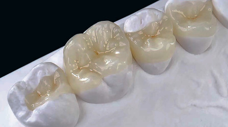 Porcelain Fillings Dental Procedure, Gurgaon