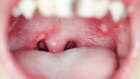 What causes White spot on tonsil