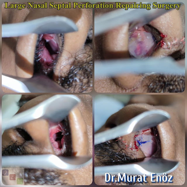 nasal septal hole closure,repairing of  septum perforation, septum perforation surgery in istanbul