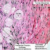 Mesothelioma most cancers Icd-nine Code