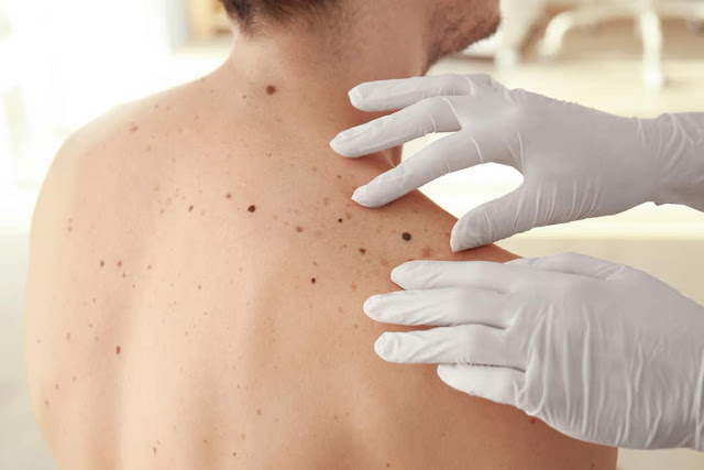 Does Skin Cancer Destructive Decline In The Family?