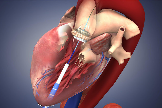 Transcatheter Heart Valve