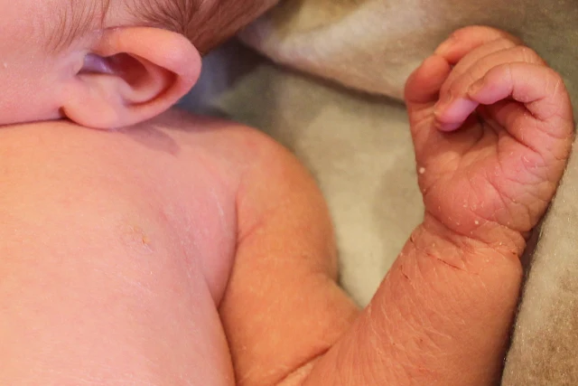 A newborn baby's hand and wrist showing dry skin and cracks