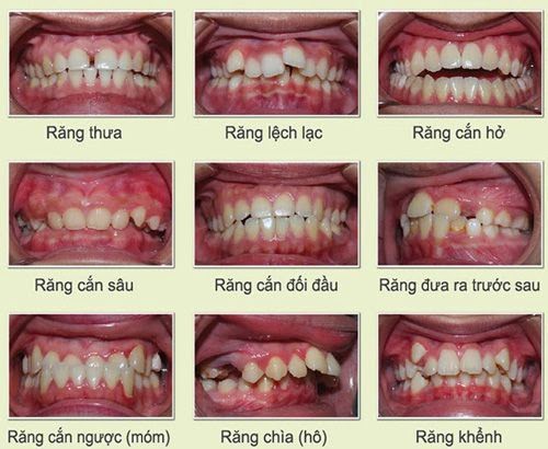 Tất cả những trường hợp răng sai lệch cơ bản đều có thể niềng răng hiệu quả