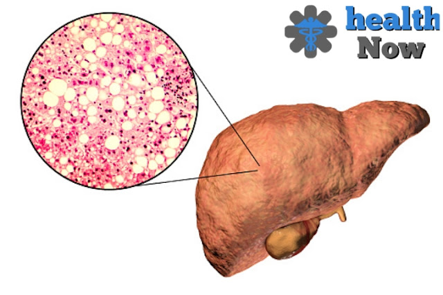 fatty liver disease