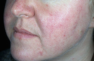 Como Quitar La Rosacea