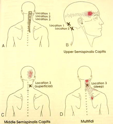 MIOTERAPIA