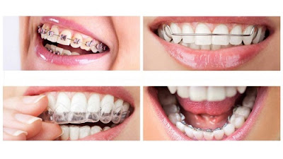 Kỹ thuật niềng răng lệch lạc là như thế nào?