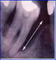 <Img src ="Radiografía-bolsa-periodontal.jpg" width = "188" height "200" border = "0" alt = "Imagen radiográfica de una bolsa periodontal.">