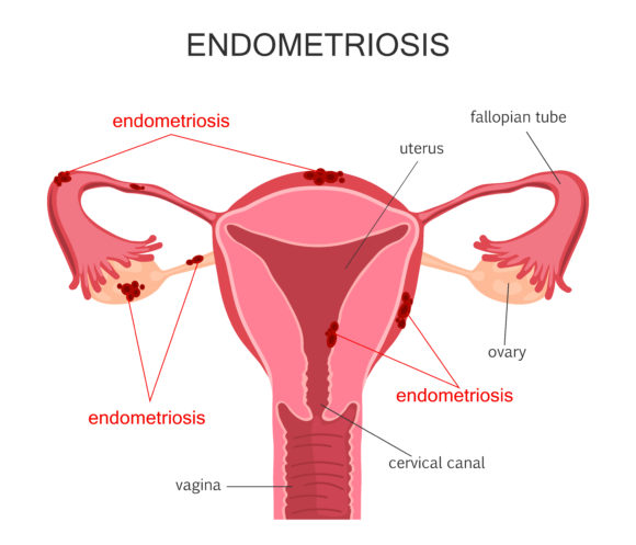 Natural remedies for treatment of Endometriosis (Ovarian cysts).