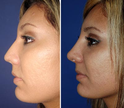 Rhinoplasty Photos