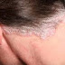 Obat Kulit kepala gatal serta mengelupas akibat gatal jamur