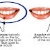 Angular Cheilitis or a Cold Sore?