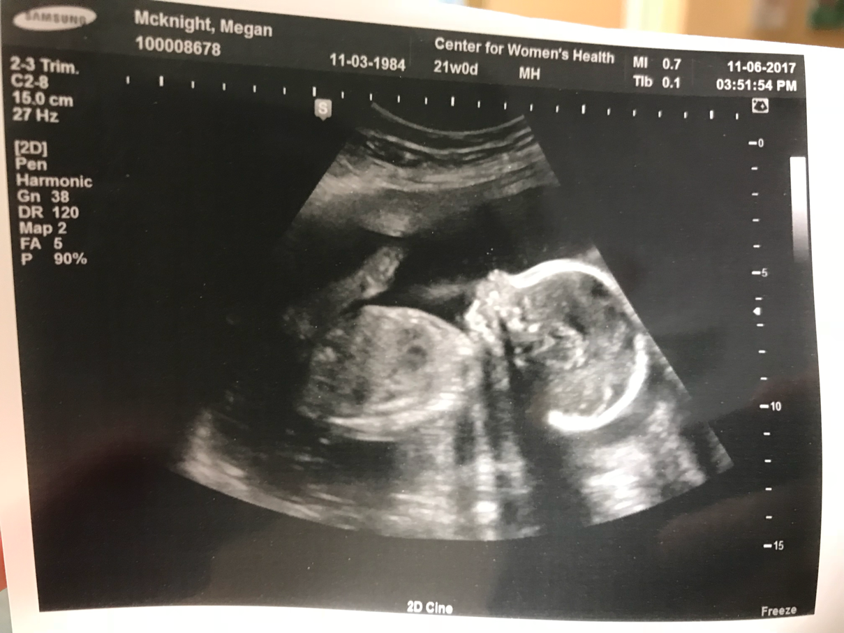 16 Week Anatomy Scan - Anatomy Drawing Diagram 16 Week Anatomy Scan - Anatomy Drawing Diagram