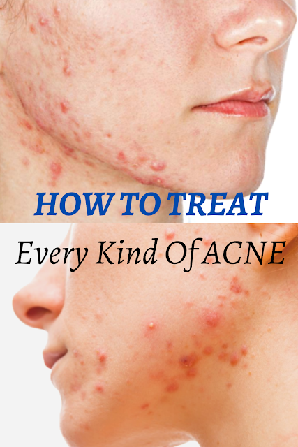 HOW TO TREAT EVERY KIND OF ACNE