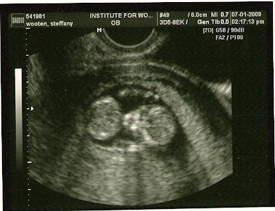 Baby Ultrasound Pictures on Ultrasounds At 13 Weeks  Baby Sonogram Pictures