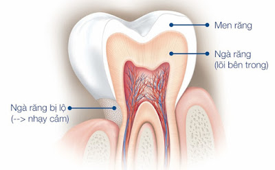 Răng bị lộ ngà bọc sứ có hiệu quả không? 1