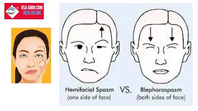 What is hemifacial spasm?